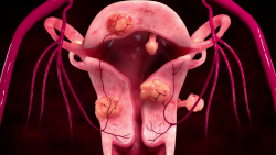 Uterine Fibroid Embolization (UFE)