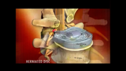 Interventional Procedures for Pam Management in the Lumbosacral Spine