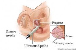 Prostate Biopsy