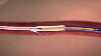 Animation of Endovenous Radiofrequency