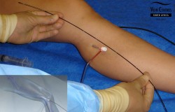 Varicose veins definite treatment by RF