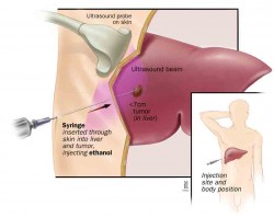 Radiofrequency Ablation (RFA) of Liver Tumors