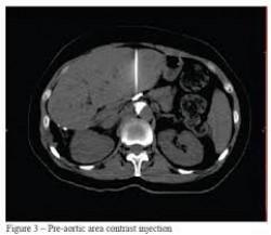 CT-guided Celiac Plexus Neurolysis