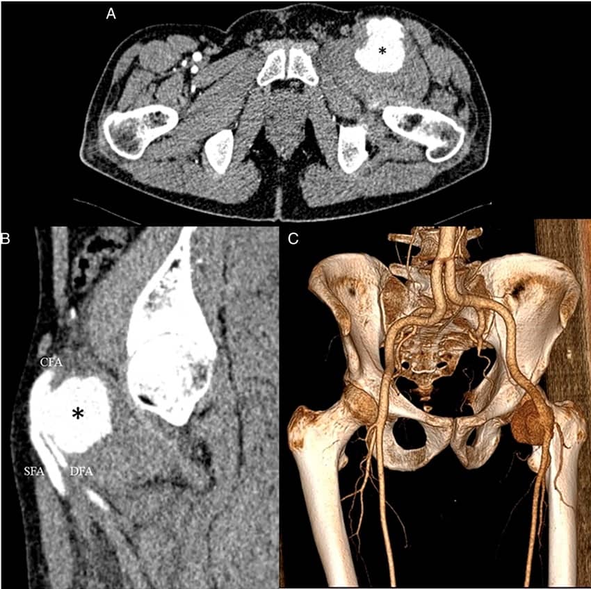 Endovascular Treatment of the Ruptured Pseudoaneurysm of Common Femoral Artery in Behcet’s Disease