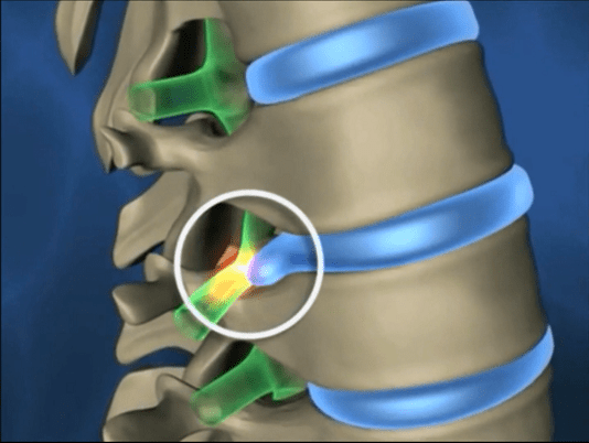 Laser-treatment-of-lumbar-disc-disease