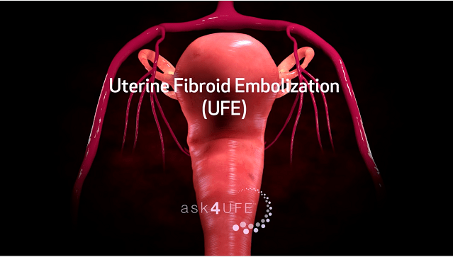 51-Uterine-Fibroid-Embolization-Treatment
