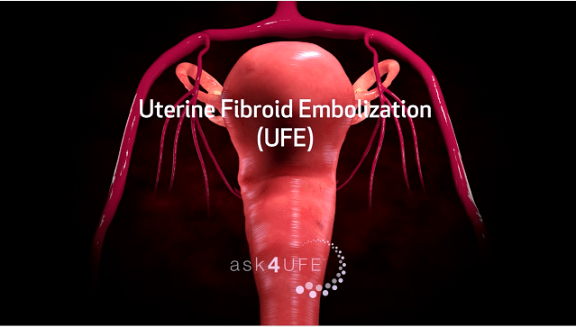 Uterine Fibroid Embolization (UFE)