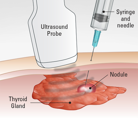 أفضل مركز FNA لأخذ العينات من الغدة الدرقيه