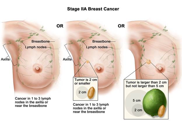 مداخلات کمتر تهاجمی رادیولوژی توده های پستان
