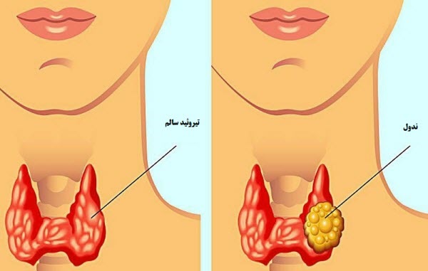 تفسير نتائج خزعة الغدة الدرقية