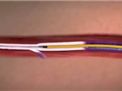 Animation of Endovenous Radiofrequency