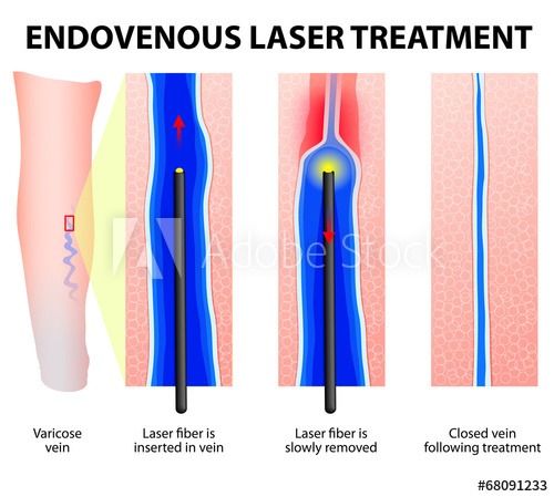 درمان رگ های واریسی با استفاده از روش لیزر / آر اف (RF) آندو واسکولار