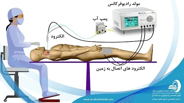 شرایط بیمار پس از ابلیشن رادیوفرکانسی آدنوم پاراتیروئید چگونه است؟